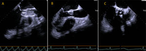 Expansión por balón de válvula percutánea visualizada con ecocardiograma transesofágico. (A) Imagen en plano que muestra eje sagital durante la expansión del balón para la colocación de la válvula percutánea. (B) Imagen luego del implante valvular en el mismo plano y transversal (C).