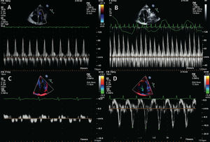 Imágenes de Doppler pulsado de la afluencia en ventrículo izquierdo (A y B) y velocidades miocárdicas en Doppler tisular de las paredes basolaterales (C y D) obtenidas de pacientes con miocardiopatía restrictiva (A y C) y PC (B y D). En constricción, hay una variabilidad respiratoria significantiva y velocidades miocárdicas en diástole temprana exageradas (E0).