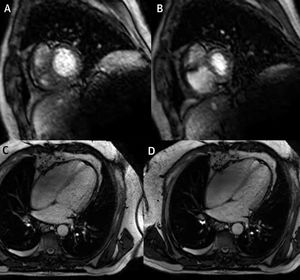 Resonancia magnética en tiempo real – imágenes obtenidas en diástole tardía en un paciente con pericarditis constrictiva. Imágenes obtenidas durante espiración (A y C) y durante inspiración (B y D), que muestran los cambios en los volúmenes de VD y VI debido a interdependencia ventricular exagerada.