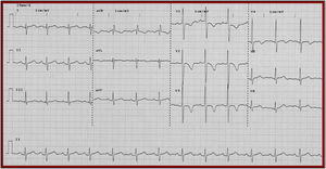 Electrocardiograma de paciente con cardiopatía de estrés. * Fuente: Archivo docente. Hospital Universitario San Ignacio – Pontificia Universidad Javeriana.