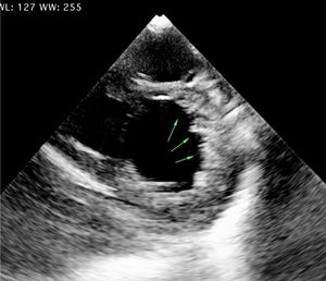 Vista de eje corto por ecocardiografía 2D. Paciente femenina de 15 años con miocardiopatía no compactada del ventrículo izquierdo. Se observan trabeculaciones y recesos en miocardio de la pared lateral, Laboratorio ecocardiografía, Hospital Universitario Mayor -Méderi.