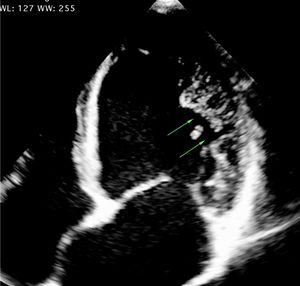 Vista de 4 cámaras por ecocardiografía 2D. Paciente femenina de 15 años de edad con miocardiopatía no compactada del ventrículo izquierdo. Se observan trabeculaciones y recesos en miocardio de la pared lateral hacia el ápex. Laboratorio de ecocardiografía, Hospital Universitario Mayor -Méderi.