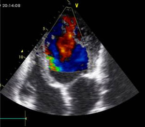 Vista de 4 cámaras con doppler color por ecocardiografía 2D. Paciente con miocardiopatía no compactada del ventrículo izquierdo. Se observan trabeculaciones y recesos con flujo en comunicación directa con la cavidad ventricular.