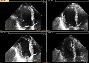 Proyección de 4 cámaras con mejoría de la contractilidad notoria en el ápex y disminución de los volúmenes ventriculares en máxima dosis y recuperación.