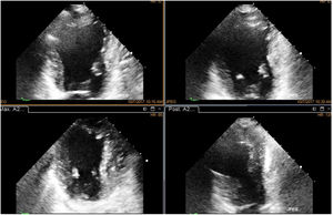 Imágenes correspondientes al paciente anterior en proyección de dos cámaras. A la derecha pared inferior y a la izquierda pared anterior. Nótese el menor volumen del ventrículo en dosis bajas y máximas como resultado de la mejor contractilidad.