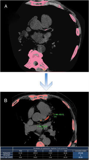 Se ilustra la manera como el sistema de tomografía coronaria multicorte detecta la presencia de calcio (A) y mediante el software realiza el cálculo e informa de manera inmediata el puntaje de calcio de la arteria coronaria (B) con el valor correspondiente.