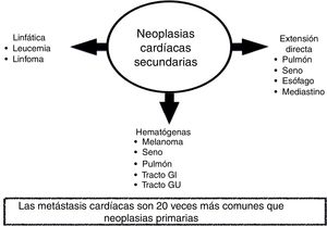 Mecanismos de diseminación de las neoplasias cardíacas secundarias.