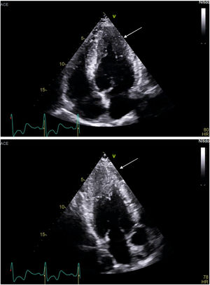 Ecocardiografía: proyecciones apicales (4 cámaras y 3 cámaras) de paciente con miocardiopatía hipertrófica apical.