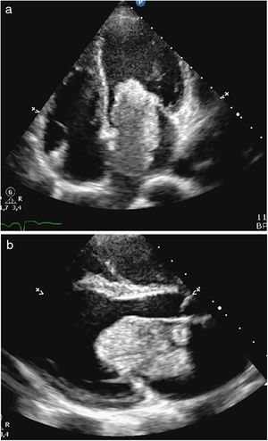 a y b Ecocardiografía transtorácica, que muestra masa bien definida en la aurícula izquierda, compatible con mixoma, que ocluye el tracto de entrada del ventrículo izquierdo en un 90% (a: vista paraesternal eje largo; b: vista de cuatro cámaras).