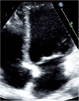 Ecocardiografía transtorácica que muestra imagen sin lesión residual (vista de cuatro cámaras).