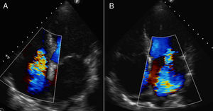 Ecocardiograma transtorácico en el que se objetiva afectación reumática polivalvular: insuficiencia tricúspide reumática severa (A), insuficiencia mitral reumática severa (B). Destaca la dilatación severa biauricular y la disfunción ventricular izquierda moderada.