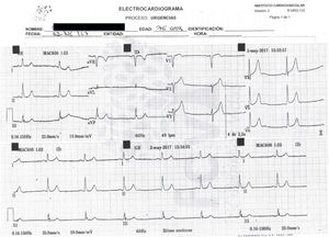 Electrocardiograma de 12 derivaciones.
