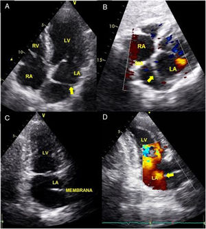 Ecocardiograma transtorácico bidimensional. A. Corte apical 4 cámaras que muestra aurícula izquierda divida en dos compartimientos, separados por una membrana (flecha), proximal y distal. (B) Ventana subcostal que muestra septum interauricular íntegro y una membrana a nivel del foramen oval separando la aurícula izquierda en dos compartimientos. C. Corte apical 2 cámaras que muestra aurícula izquierda dividida por una membrana discontinua (flecha) sin producir gradiente entre las dos cámaras. D. RV: ventrículo derecho; RA: aurícula derecha; LV: ventrículo izquierdo; LA: aurícula izquierda.