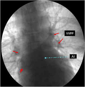 Cateterismo cardíaco que muestra el retorno venoso a la aurícula izquierda sin que se observen estructuras internas definidas tipo membrana. VVPP: venas pulmonares; AI: aurícula izquierda.
