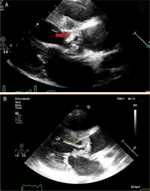 Transthoracic parasternal long-axis view showing (A) a mobile mass on the sub-aortic diaphragm (arrow) (B) leading to a direct contact with the anterior mitral valve “kissing vegetation”.