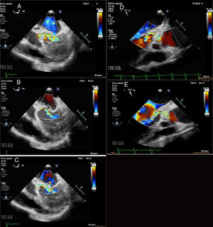Color Doppler flow on TEE showing the aortic regurgitation “jet lesion” on the atrial surface of the anterior mitral valve leaflet, and the mitral regurgitation through the perforation of the mitral valve aneurysm (TEE, transesophageal echocardiography).