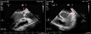 Transesophageal echocardiography (A) three chamber view revealing an anterior mitral leaflet aneurysm and an abscess in the aortic mitral intervalvular fibrosa (arrow) suggesting the local extension of infection and (B) four chamber view showing the saccular bulging on the anterior mitral valve (arrow).