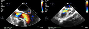 Imagen tomada durante ecocardiografía transesofágica en la cual se evidencia turbulencia del flujo en la válvula aórtica y el tracto de salida del ventrículo izquierdo, explicada por insuficiencia aórtica severa.