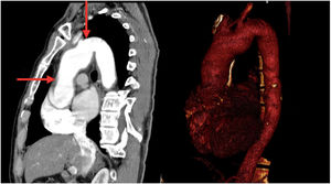Vista tomográfica y reconstrucción 3D que evidencia dilatación aneurismática de la aorta ascendente. Las flechas rojas delimitan la extensión de la misma. El aneurisma fue de 45mm de diámetro y, por tanto, no requirió corrección.