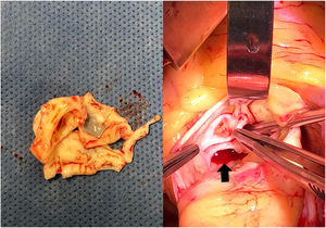 Imagen en la que se evidencia resección de válvula aórtica trivalva para posterior recambio valvular aórtico. Con flecha de color negro se resalta la perforación de la valva coronariana derecha.