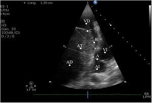El ecocardiograma muestra un corte apical de 4 cámaras modificado para ver el ventrículo derecho. Se observa una dilatación de la aurícula derecha y del anillo tricúspide. También se observa una valva septal apicalizada y atrialización del ventrículo derecho mayor del 50%. La distancia entre la implantación del anillo mitral y tricúspide fue de 10 mm/m2.AI: aurícula izquierda; AD: aurícula derecha; VI: ventrículo izquierdo; VD: ventrículo derecho; AT: atrialización del ventrículo derecho. A: valva septal de la válvula mitral. B: valva septal de la válvula tricúspide. C: dilatación del anillo tricúspide.