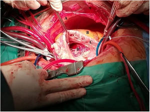 Fotografía de la cirugía. Se pueden observar el músculo ventricular, las cuerdas tendinosas y la válvula tricúspide. A. Pericardio seroso. B. Grasa epicárdica. C. Músculo papilar. D. Ventrículo derecho.