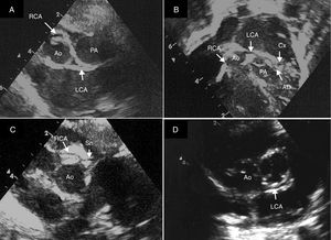 Transthoracic echocardiography, (A, C, D) short-axis view and (B) modified apical view, showing coronary arteries origin. Double coronary looping in association with two separate ostia, where left coronary artery arises from the posterior-facing sinus, whereas the right coronary artery arises from the aorta anteriorly. A retropulmonary course of left pulmonary artery can be noticed, dividing posteriorly into the circumflex and anterior descending arteries. We can also appreciate the first branch from the RCA, probably the sinus node artery, which typically arises as the first vessel. Ao: aorta; PA: pulmonary artery; LCA: left coronary artery; RCA: right coronary artery; Cx: circumflex artery; AD: anterior descending artery; Sn: sinus node artery.