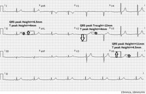 Criterios de medición del QRS-T en el electrocardiograma. Medición de la amplitud del complejo QRS y la onda T en milímetros, a partir del segmento TP. Tomado con permiso del Dr. Daniel Cortez.
