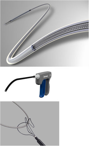 Dispositivos empleados en procedimientos de extracción. Dispositivo LLD. Desplegado en el interior de cable de marcapasos (arriba). Dispositivo TightRail (medio). Needle's eye snare. Sistema de doble lazo (abajo).