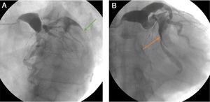 A Gran trombo en la arteria circunfleja (flecha verde) y adicionalmente gran ectasia del tronco coronario. B. Ectasia de la arteria coronaria izquierda y gran trombo en la arteria circunfleja (flecha naranja).