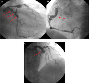 A. Múltiples dilataciones aneurismáticas en la arteria circunfleja. (flechas). B. Arteria coronaria derecha con ectasia en su tercio proximal y medio (flecha). C. Aneurisma en la arteria descendente anterior en su tercio proximal (flecha).