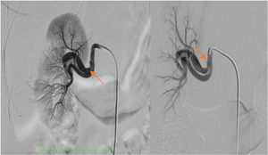Arteriografía renal derecha que sugiere displasia fibromuscular y oclusión distal de una arteria polar con ectasia asociada. Las flechas señalan estenosis pequeñas en diferentes territorios de la arteria renal.