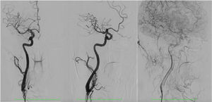 Carótida interna derecha durante angiografía final; no se observa el flap de disección ni pseudoaneurisma. El flujo es normal.