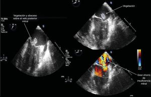 Imágenes de ecocardiografía transesofágica que muestran absceso de 14 x 8mm con perforación del velo posterior mitral que condiciona insuficiencia mitral severa.