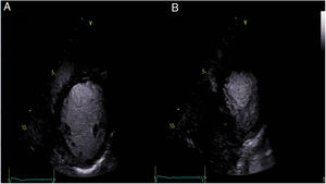 Áreas de no compactación en región postero-lateral medio-apical.