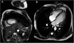 Áreas de no compactación en región posterolateral medio-apical sin realce tardío.
