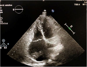 Ecocardiograma transtorácico en proyección de cuatro cámaras, en el que se observan dos masas en la aurícula derecha.