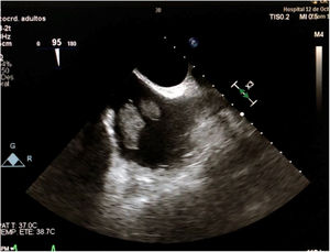 Ecocardiograma transesofágico en una proyección en la que se observan las cavas y se evidencian dos masas en la desembocadura de la vena cava inferior, dependientes de la válvula de Eustaquio.