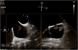 Se observan las dos masas alcanzando el septo interauricular sin comprometer la función de la válvula tricúspide en el ecocardiograma transesofágico.