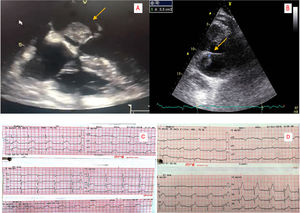 A. Electrocardiograma que muestra lesión subepicárdica en la pared inferior y lateral. B. Electrocardiograma postrombólisis en el que se evidencia mejoría del supradesnivel del segmento ST. C. Imagen del mixoma en el ecocardiograma transesofágico. D. Imagen del mixoma en ecocardiograma transtorácico.