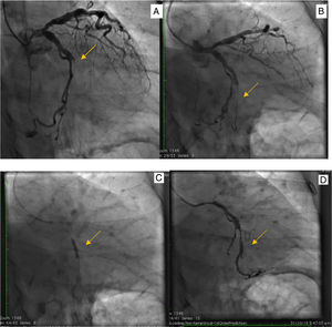 A. Arteriografía coronaria en proyección oblicua derecha con caudal con oclusión del 100% de la arteria circunfleja. B. Paso de guía de angioplastia coronaria 0,014”. C. Angioplastia con balón, D. Tromboaspiración con catéter y posterior inyección control con medio de contraste que evidencia flujo anterógrado de la arteria circunfleja muy discreto TIMI 0-I.