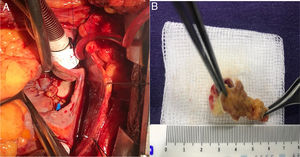 A. Fotografía de la cirugía cardiovascular para extirpación de mixoma auricular; vista superior de esternotomía con exposición del corazón y tubo anillado de circulación extracorpórea. B. Pieza quirúrgica obtenida.