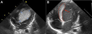 A. Imagen de rabdomioma cardiaco, caso 1; vista apical cuatro cámaras. Ecocardiograma 2 D. Se observa una gran masa de 30mm x 30mm homogénea, de bordes limitados, que compromete todo el septum interventricular, la cual se extiende hacia la cavidad ventricular izquierda con disminución del calibre del tracto de salida sin generar gradiente. B. Ecocardiograma 2D: imagen de rabdomioma cardiaco, caso 1. Posterior a manejo con everolimus; vista apical cuatro cámaras. La flecha señala una masa homogénea, de bordes limitados, móvil, de 7 x 23 mm, que compromete todo el septum interventricular, y la cual, previo a manejo con everolimus, tenía unas dimensiones de 30 x 30 mm, con extensión a la cavidad ventricular y disminución de aproximadamente 40% del tamaño.