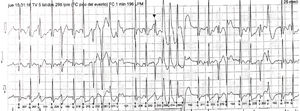 Trazado electrocardiográfico de Holter 24 horas. Se evidencian extrasístoles ventriculares de diferente morfología, en bigeminismo, trigeminismo, dupletas, tripletas y episodios de taquicardia ventricular polimórfica, así como extrasístoles supraventriculares ocasionales, algunas con conducción aberrante.