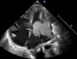 Ecocardiograma 2D vista apical (cuatro cámaras). Se observa una gran masa homogénea, móvil, de bordes limitados, de 28 x 25 mm, que compromete la cruz del corazón y se extiende hacia su interior. Hay obstrucción severa en el tracto de entrada del ventrículo izquierdo. Se observan múltiples masas de iguales características y diferentes tamaños en ambos ventrículos.