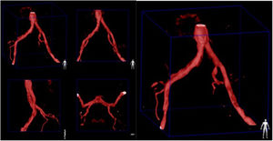 Segmento vascular seleccionado 3DRA. Fuente: los autores.