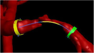Implante de un stent virtual 3DRA. Fuente: los autores.