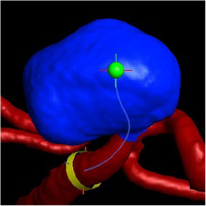 Rastreo vascular para insertar dispositivo en aneurisma 3DRA. Fuente: los autores.