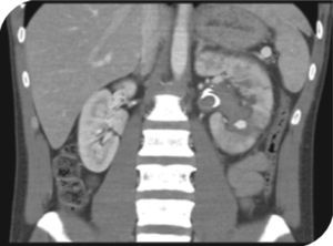 Angiografía por tomografía: pseudoaneurisma intrarrenal dependiente de la rama polar inferior izquierda.