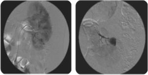 Arteriografía renal que evidencia el pseudoaneurisma intrarrenal Izquierdo.
